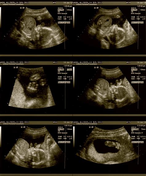 what is cas ultrasound|20 Week Ultrasound (Anatomy Scan): What to Expect.